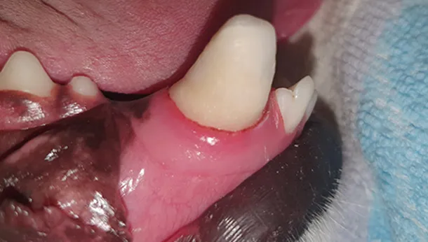 dévitalisation et résultat de la restauration dentaire