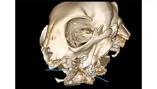 Scanner: fracture complexe de la machoire inférieure