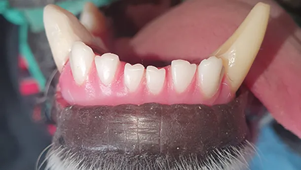 dévitalisation 2 et résultat de la restauration dentaire