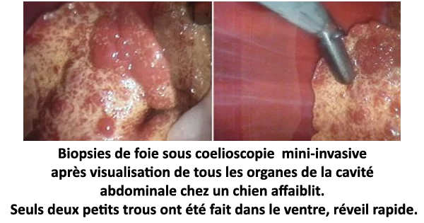 Biopsies de foie sous coelioscopie mini-invasive