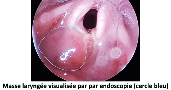 Masse laryngée visualisée par par endoscopie (cercle bleu)