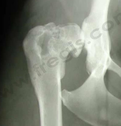 Radiographie des hanches d'un chien adulte présentant une dysplasie de hanche. L’articulation est totalement remodelée par de l'arthrose ce qui lui donne un aspect en champignon