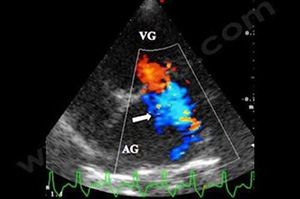 Echocardiographie avec Doppler codé couleur sur un Doberman atteint d'une CMD