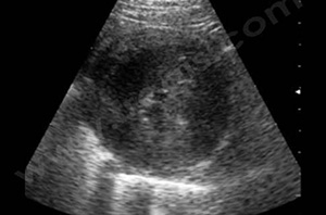 Echocardiographie d’un chat présentant une forme grave de cardiomyopathie hypertrophique secondaire à une hyperthyroïdie