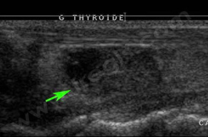 Echographie de la thyroïde d’un chat souffrant d’hyperthyroïdie