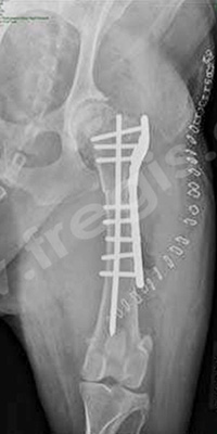 Fracture du fémur réparée par une plaque, des vis et un clou centro-médullaire