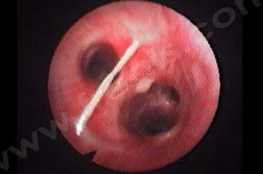 Image endoscopique de bronches