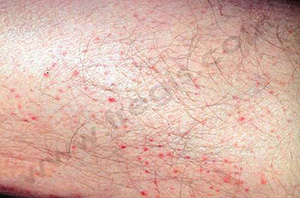 Lésions de cheyletiellose chez un humain (Cliché F. Leone)
