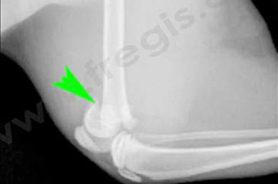 Radiographies d’une fracture du cartilage de croissance du fémur distal