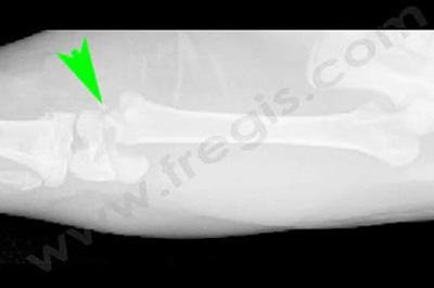 Radiographies d’une fracture du cartilage de croissance du fémur distal 2