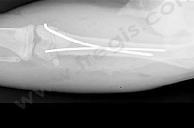 Radiographie fracture pédiatrique chez le chat : post-op 2