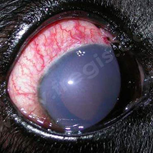 glaucome aigu avec une très forte élévation de la pression intra-oculaire