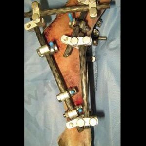 Chirurgie d’une rupture du tendon d’Achille (corde du jarret)