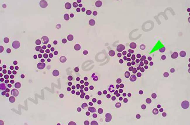 Déficit en spectrine avec des globules rouges qui peuvent être anormalement sphériques (sphérocytes) (flèche verte) (photo laboratoire Vebiotel)