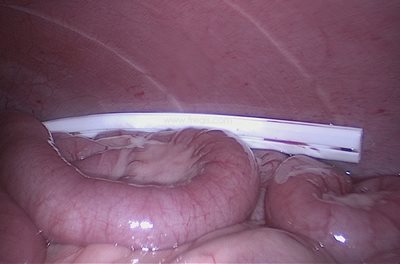 Leptospirose chez le chien, mise en place d’un drain de dialyse péritonéale dans l’abdomen​