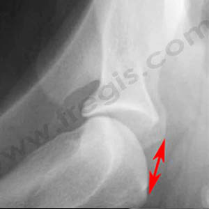 radiographique de face de l’épaule d’un chien présentant une luxation/instabilité de l’épaule