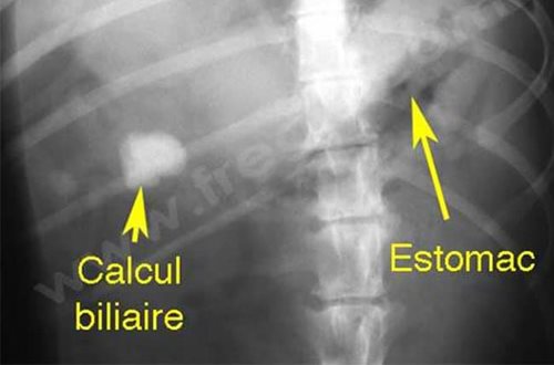 Radiographie d’un chien présentant un volumineux calcul dans la vésicule biliaire
