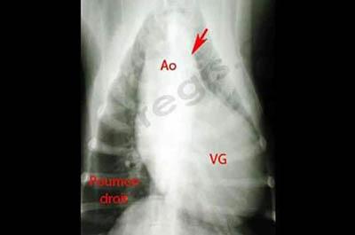 1. Radiographie du thorax d’un chien Boxer atteint d’une sténose aortique sévère. L’aorte (Ao) est très anormalement dilatée (flèche) et le ventricule gauche (VG) est très hypertrophié, allant jusqu’à toucher les côtes