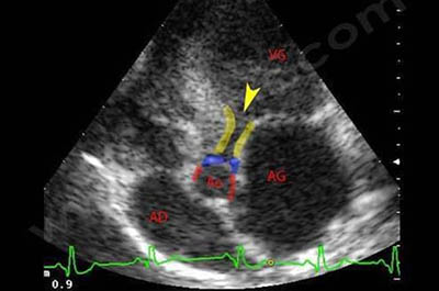 2. Echocardiographie d’un chien Berger allemand atteint de sténose aortique. Le sang venant du ventricule gauche (VG) a du mal à passer vers l’aorte (Ao), à cause d’un véritable tunnel fibreux très étroit (délimité par les traits jaunes). L’oreillette gauche (AG) est très dilatée par rapport à la droite (AD). En bleu, la valve aortique