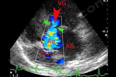 Echocardiographie et Doppler couleur chez un chien Bull terrier avec grave sténose aortique. Le flux sanguin (flèche rouge) entre le ventricule gauche (VG) et l’aorte (Ao) est anormalement étroit au niveau de la sténose (flèches vertes). L’aorte est également très dilatée. (AG : oreillette gauche)