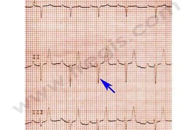 Electrocardiogramme (ECG) d’un chien de race West Highland White terrier (WHWT). Les modifications induites par la sténose pulmonaire se traduisent ici par une grande onde négative (flèche).