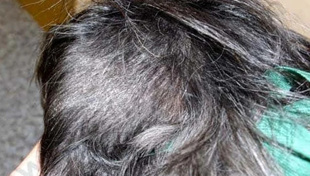 L’alopecia areata chez le chien