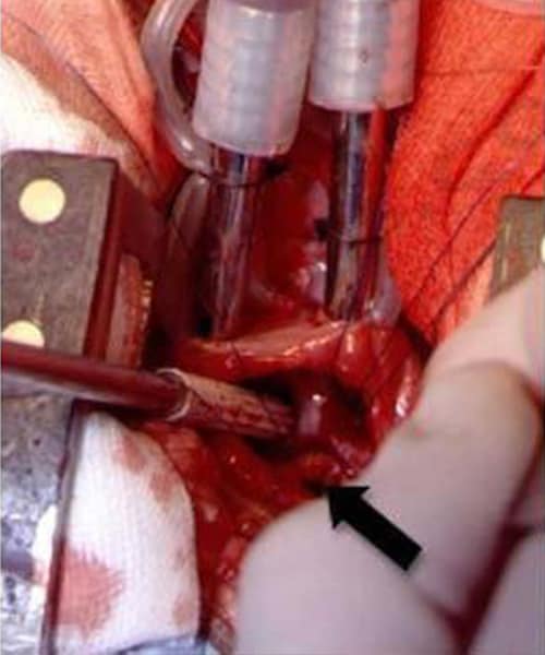 Opération à coeur ouvert sur un jeune chien présentant une communication anormale entre les 2 ventricules (flèche)