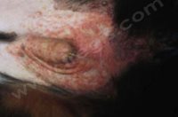 2. Chiot de race Bouvier bernois présentant une dermatose répondant au zinc de type 2. Présence d’un érythème et de croûtes au niveau du ventre