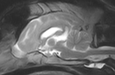 Images IRM (sagittale T2) montrant l'atrophie du cervelet.