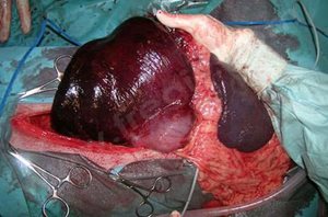 Vue per-opératoire d’une dilatation avec torsion de l’estomac. Une souffrance importante avec des signes de nécrose est notée