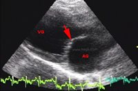 1. Echographie cardiaque d’un chien présentant une sténose mitrale. La valve est ici normalement fermée (flèche rouge). (VG : ventricule rouge ; AG : atrium (ou oreillette) gauche)
