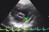 2. Dans cette forme de dysplasie mitrale, un anneau fibreux (flèche verte), empêche le fonctionnement normal de la valve (flèche verte). (VG : ventricule gauche)​