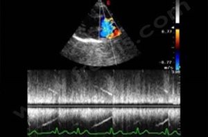 Echocardiographie-Doppler d'un cas de persistance du canal artériel