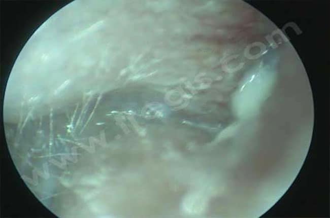 Endoscopie chez le lapin Otoscopie d’une oreille de Lapin bélier atteint d’otite - CHV Fregis