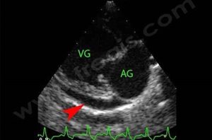 1. Echographie cardiaque chez un chien présentant un épanchement péricardique (flèche) secondaire à une maladie cardiaque avancée. (VG : ventricule gauche ; AG : oreillette gauche)