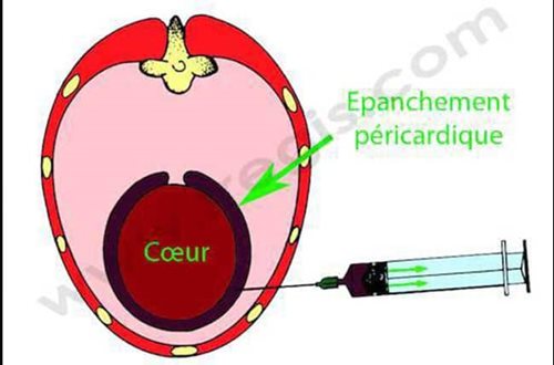 La péricardiocentèse est le traitement d’urgence de choix en cas de tamponnade cardiaque. Elle consiste, à l’aide d’une aiguille, à retirer le liquide (épanchement péricardique) qui comprime le cœur. La ponction est généralement réalisée sous contrôle échographique.