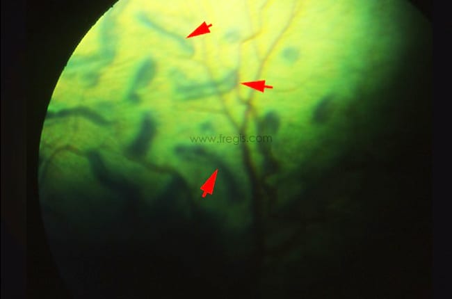 ​Examen du fond d’œil chez un chien Colley présentant une dysplasie rétinienne se traduisant par de multiples plis rétiniens vermiformes dans la zone du tapis.