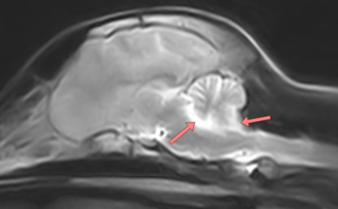 Images IRM (sagittale T2) montrant l'atrophie du cervelet.