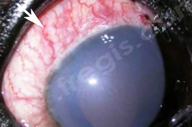 Chien Terre-Neuve présenté pour abattement et perte de la vision. Il s’agit ici d’un glaucome aigu avec vaisseaux de la conjonctive (flèche) très rouges, voile bleuté (œdème) sur la cornée.