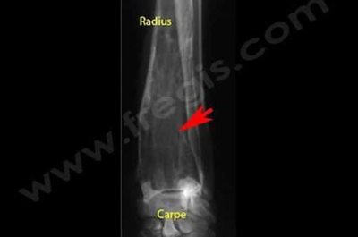 Radiographie de la patte avant d’un chien atteint d’un hémangiosarcome osseux. A la radio, l’extrémité du radius apparaît avec une densité anormalement « transparente » et irrégulière (flèche)