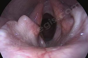 2. Aspect du larynx après la chirurgie