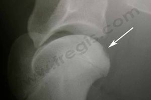 Aspect radiographique typique d’une ostéochondrite (ou OCD) d’épaule chez un chien de race boxer de 8 mois