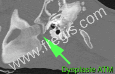 Ostéopathie craniomandibulaire du chien, scanner montrant une atteinte de l’articulation temporo-mandibulaire