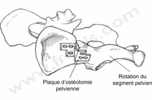 1. Implant d’ostéosynthèse utilisé dans la réalisation d’une TOB avec ventroversion de l’acétabulum. (D’après Piermattei)