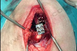 2. Visualisation per-opératoire de la mise en place de l’implant