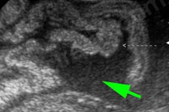 Echographie abdominale chez un chat atteint de PIF « forme humide ». L’épanchement abdominal est ici important (flèche verte)