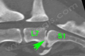 1. Scanner de la région lombo-sacrée du même chien en reconstruction sagittale et transverse. L’espace intervertébral entre L7 et S1 est collabé, une prolifération osseuse ventrale est présente. La coupe transverse met en évidence des zones lytiques au niveau des plateaux vertébraux