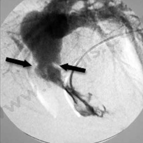 1. Radiographie avec préparation (angiographie) montrant un rétrécissement anormal d'un vaisseau à la sortie du coeur, matérialisé sous forme de deux petits traits blancs (flèches)