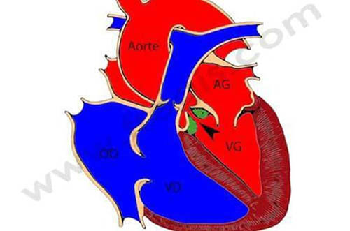 Photo 1 : Sténose aortique chez le chien. Lors de la contraction du cœur, le sang contenu dans le ventricule gauche (VG) a du mal à passer dans l’aorte (flèche), à cause d’un anneau fibreux (en vert) sous la valve aortique. (AG : oreillette gauche ; AD : oreillette droite ; VD : ventricule droit)