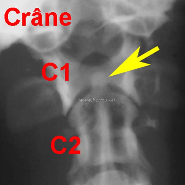 1. Radiographie de face de l’articulation atlanto-occipitale d’un chien sain. La dent de l’axis est clairement visible (flèche jaune)